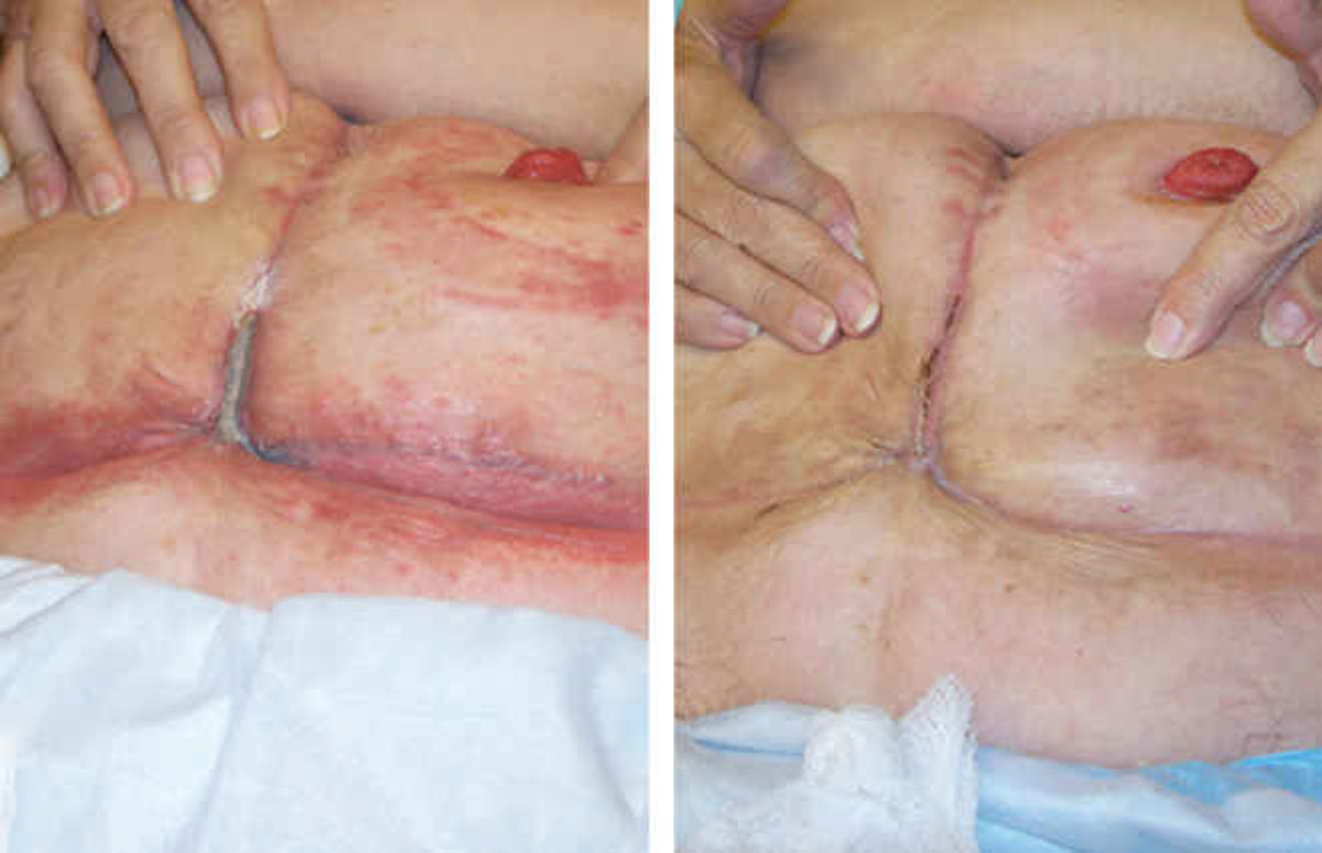 See how InterDry resolves skin fold complications