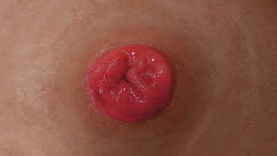 stoma