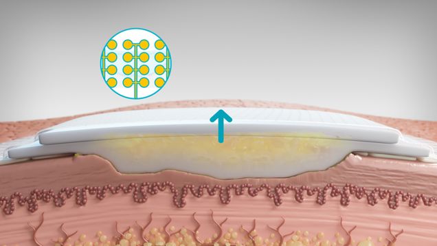 Graphic of Biatain Silicone Fit absorbing exudate vertically into the foam.