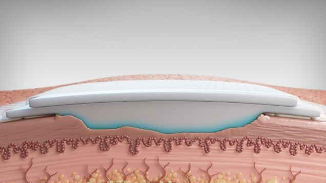 Graphic of Biatain Silicone Fit foam expanded to match the shape and depth of the wound bed. 
