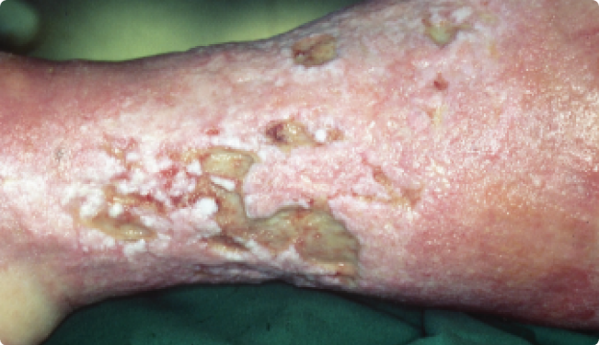 Maceration of the periwound skin