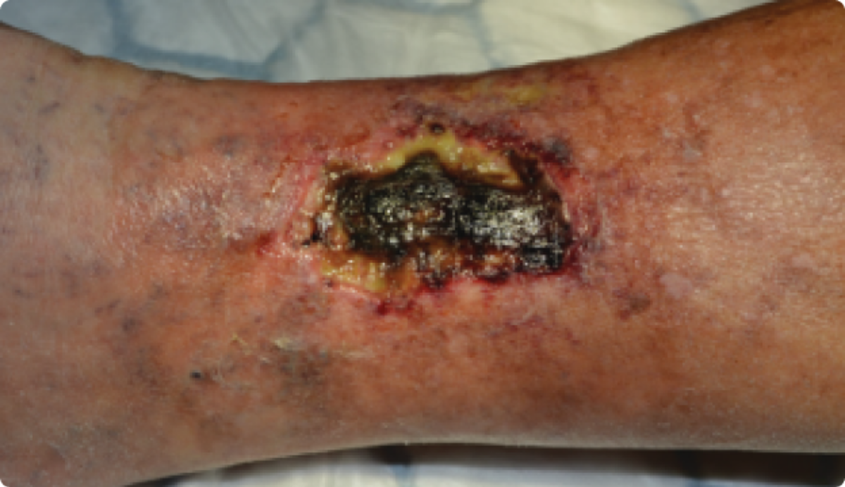 Facilitating autolytic debridement
