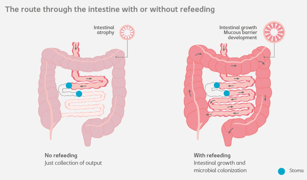 Mucous fistula refeeding