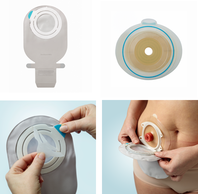 two piece pouch ileostomy