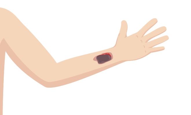 Pathways Skin Tear