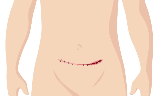 Pathways Surgical wound dehiscence