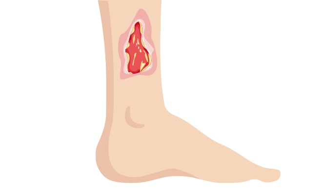 Pathways Venous Leg Ulcer