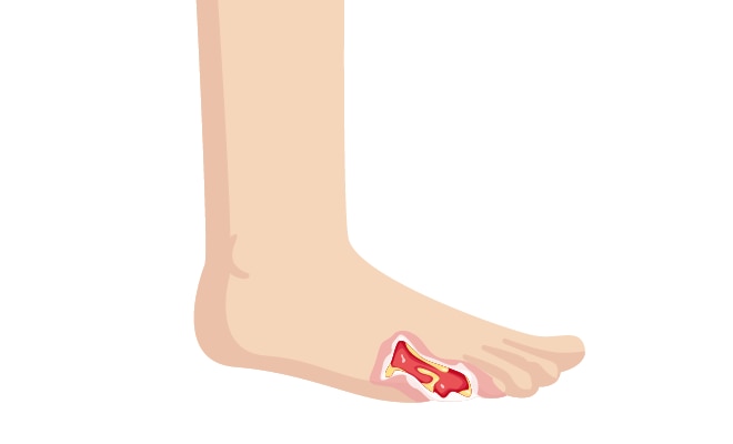 Pathways Diabetic Foot Ulcer