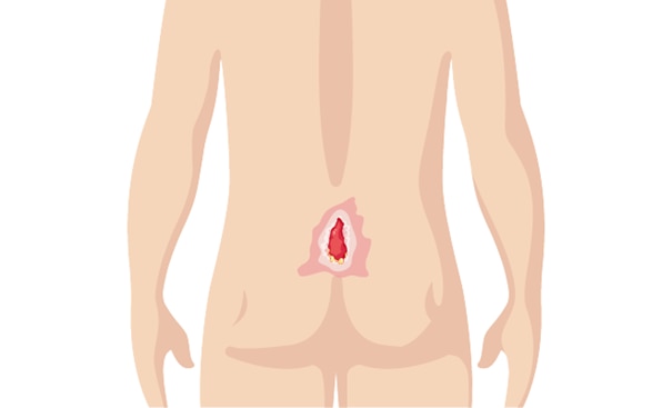 Pathways Pressure Injury Ulcer